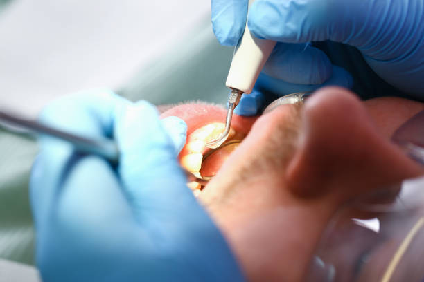Best Knocked-Out Tooth (Avulsed Tooth) Treatment in Walnut Creek, CA